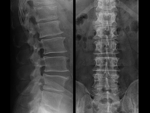 Житель Омской области сломал позвоночник и ребра при заготовке орехов