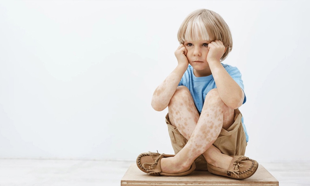 В Омской области корью заболел ещё один ребёнок 