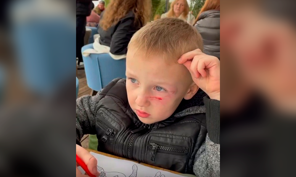 «Молодец, не боится крови»: Александр Шлеменко рассказал, что его 5-летний сын получил травмы