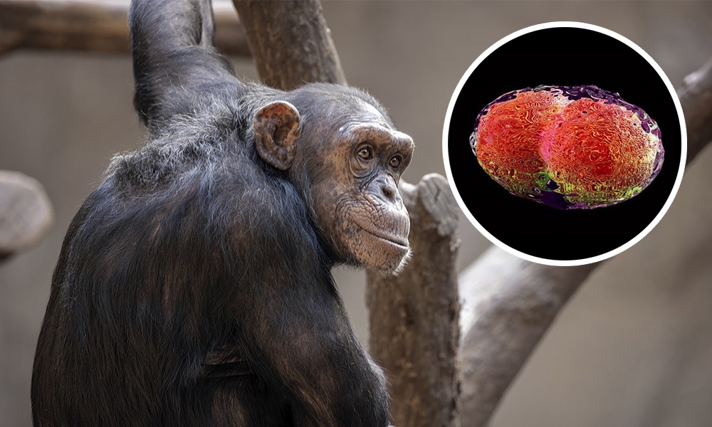 Единственного в России пациента с оспой обезьян выписали из больницы