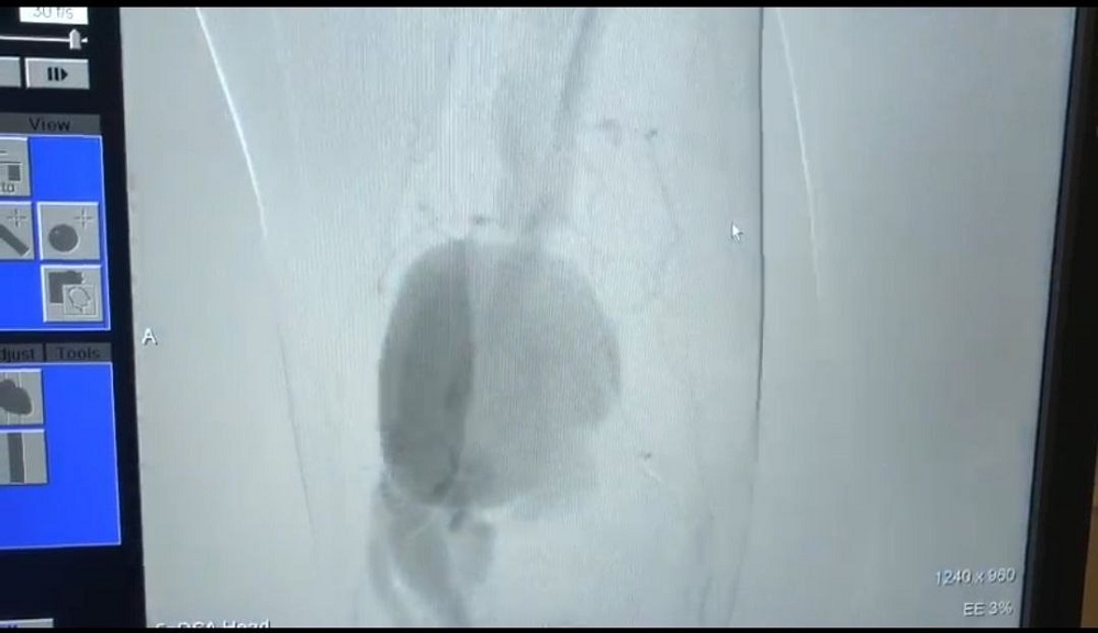 Мог лишиться ноги: омич хотел заколоть поросёнка, но случайно воткнул нож себе в бедро 