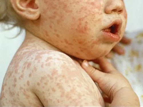 Омский роспотребнадзор напомнил, как защититься от кори